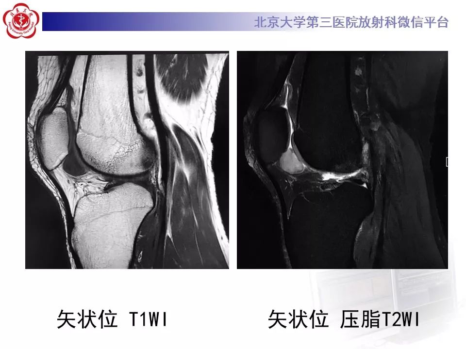 【病例】结节性筋膜炎1例MR