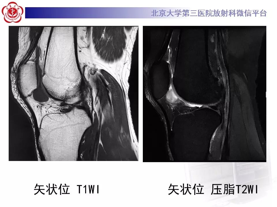 【病例】结节性筋膜炎1例MR