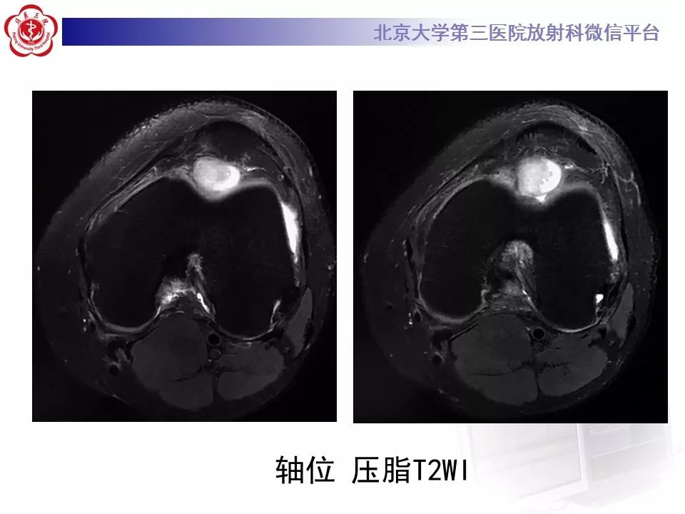 【病例】结节性筋膜炎1例MR