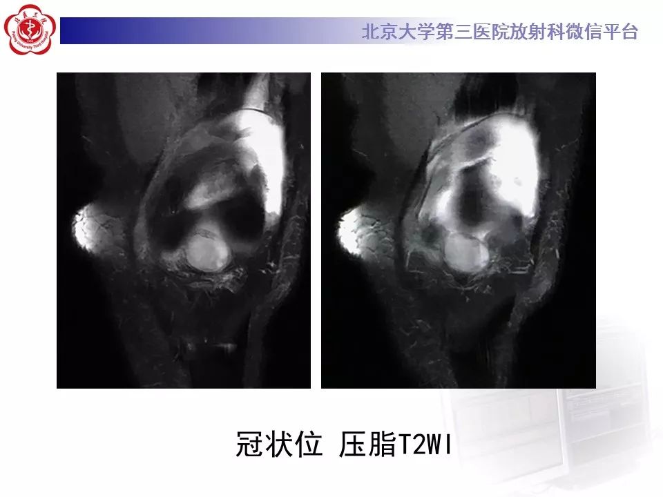 【病例】结节性筋膜炎1例MR