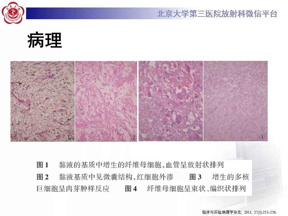 【病例】结节性筋膜炎1例MR