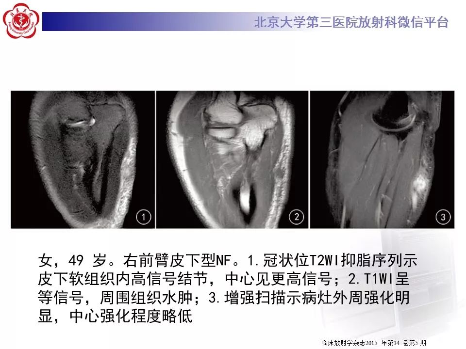 【病例】结节性筋膜炎1例MR