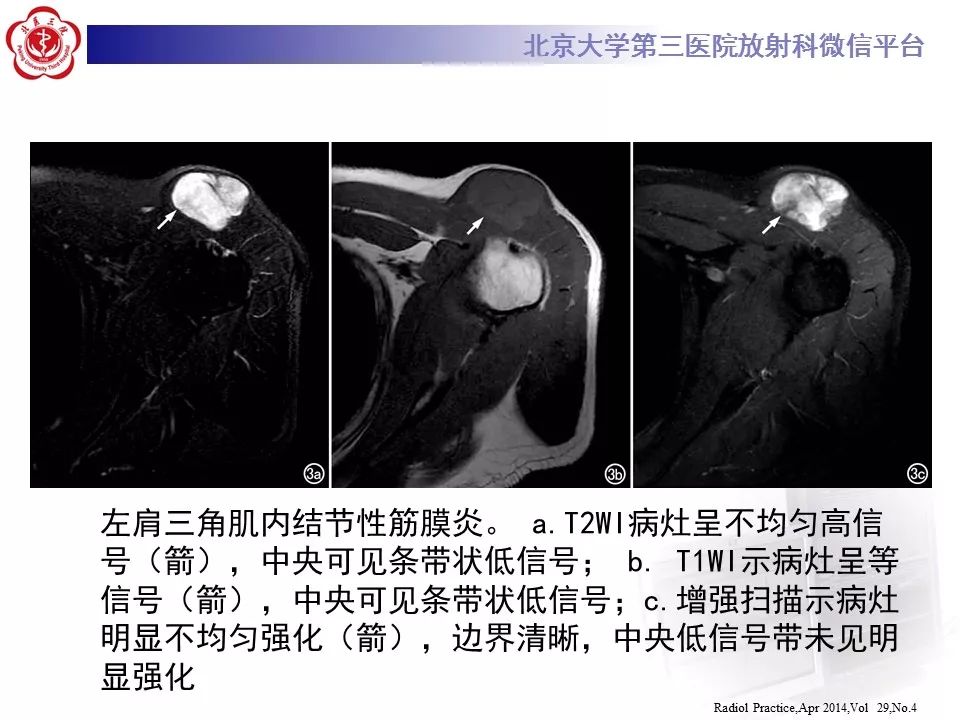 【病例】结节性筋膜炎1例MR