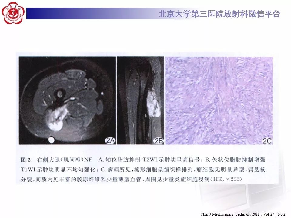 【病例】结节性筋膜炎1例MR
