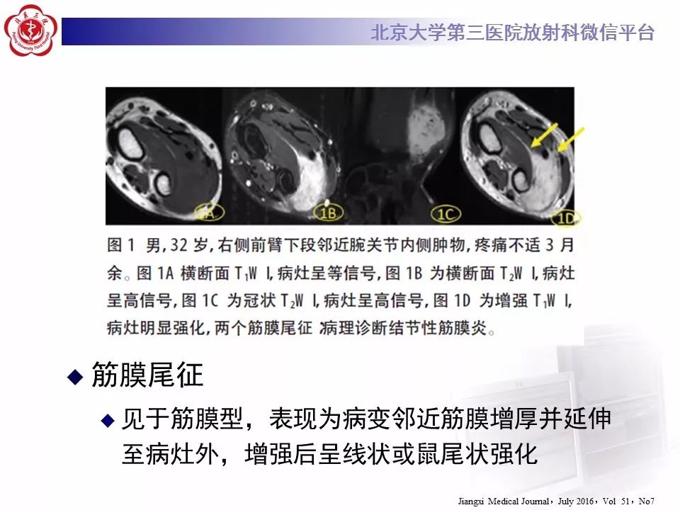 【病例】结节性筋膜炎1例MR