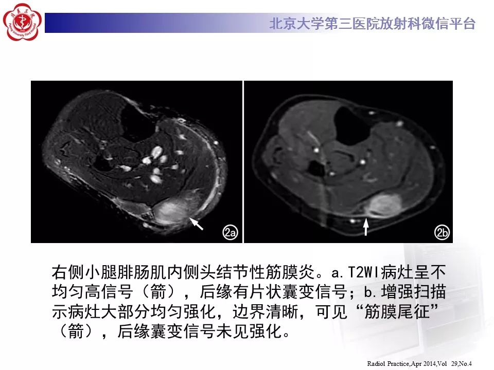 【病例】结节性筋膜炎1例MR