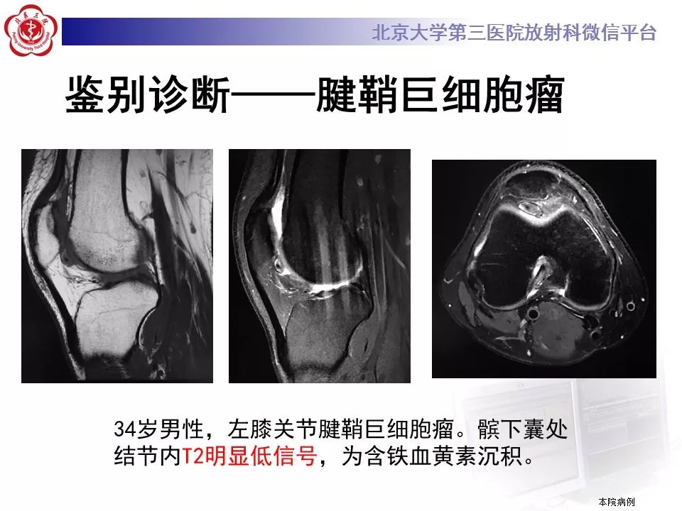 【病例】结节性筋膜炎1例MR