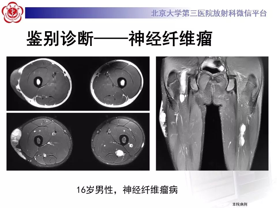 【病例】结节性筋膜炎1例MR