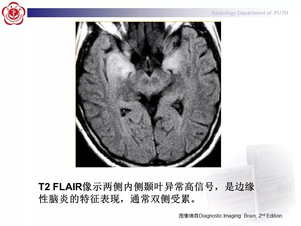 【病例】副肿瘤性边缘叶脑炎1例MR影像表现