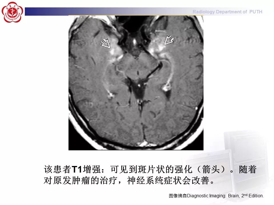 【病例】副肿瘤性边缘叶脑炎1例MR影像表现