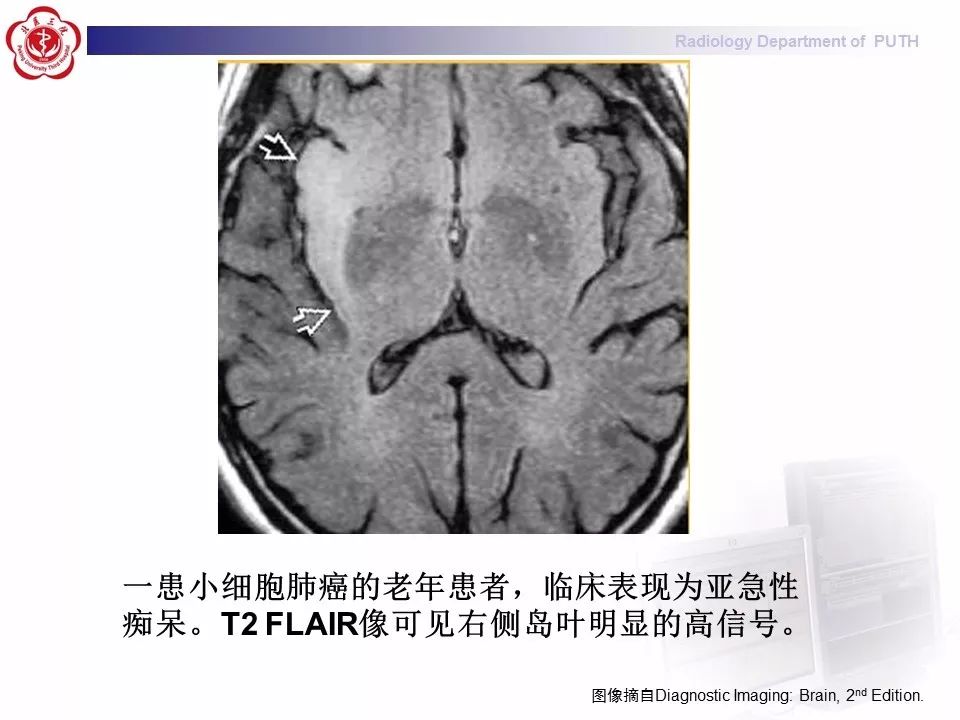 【病例】副肿瘤性边缘叶脑炎1例MR影像表现