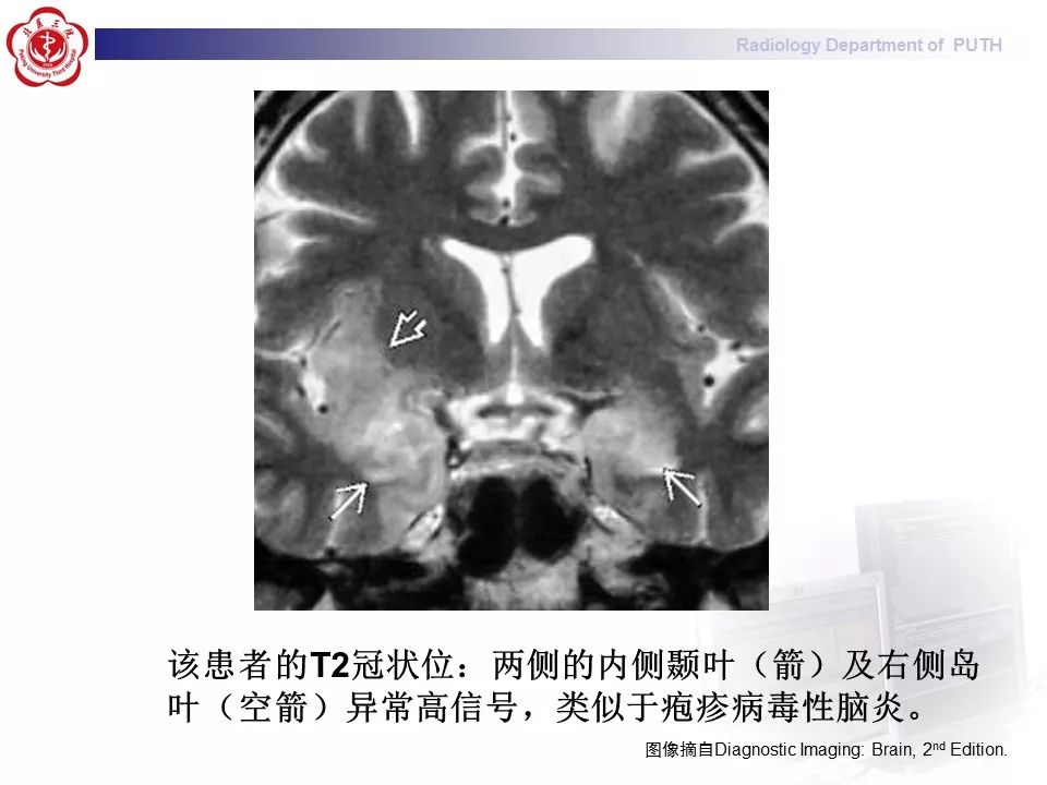 【病例】副肿瘤性边缘叶脑炎1例MR影像表现