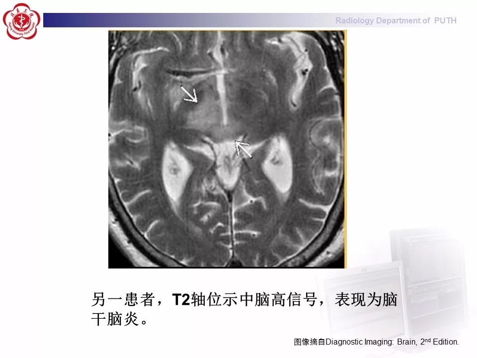 【病例】副肿瘤性边缘叶脑炎1例MR影像表现