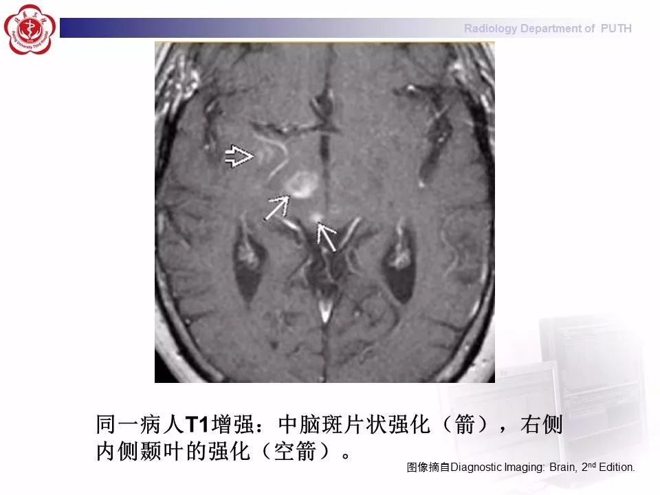 【病例】副肿瘤性边缘叶脑炎1例MR影像表现