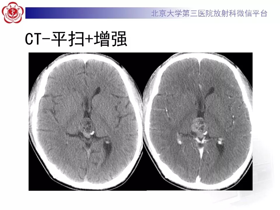 【病例】松果体区生殖细胞瘤1例CT及MR