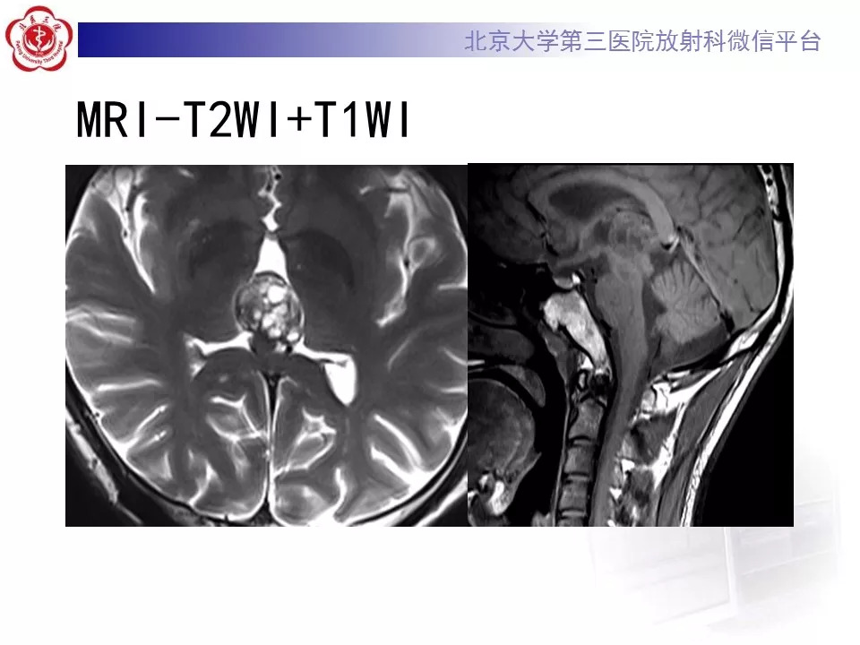 【病例】松果体区生殖细胞瘤1例CT及MR