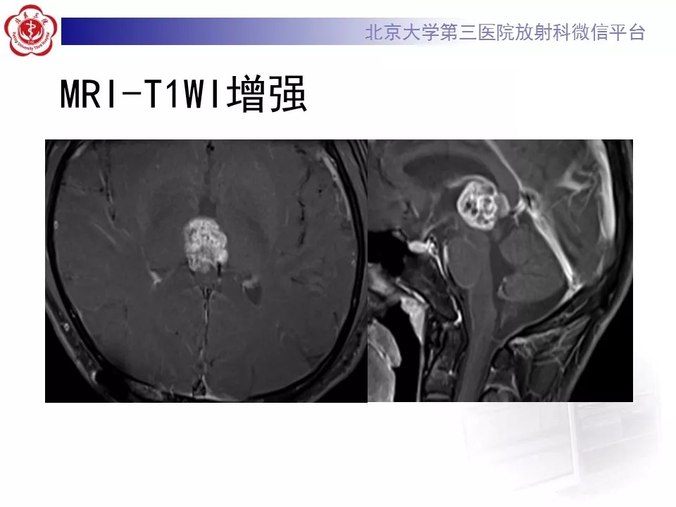 【病例】松果体区生殖细胞瘤1例CT及MR