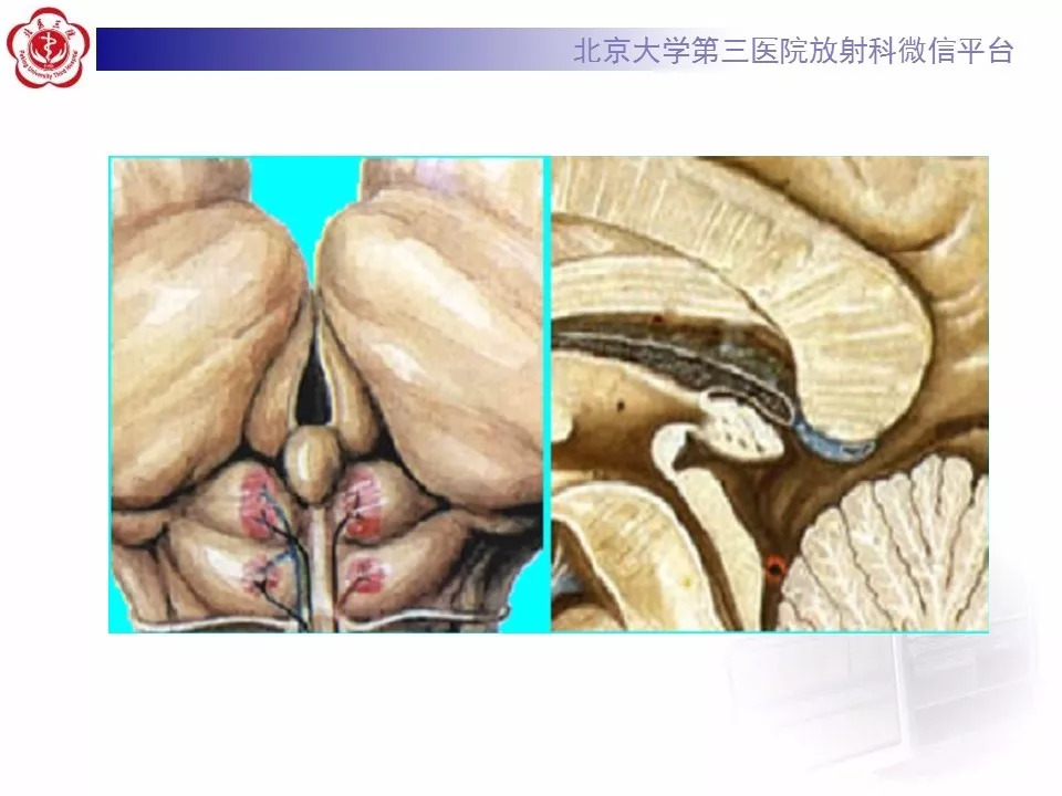 【病例】松果体区生殖细胞瘤1例CT及MR
