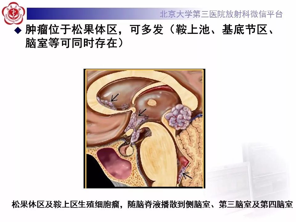 【病例】松果体区生殖细胞瘤1例CT及MR