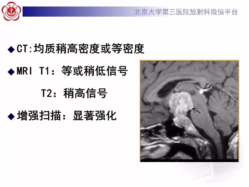 【病例】松果体区生殖细胞瘤1例CT及MR
