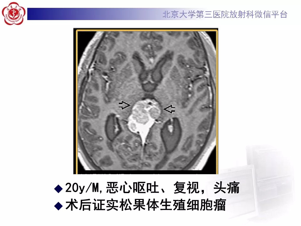 【病例】松果体区生殖细胞瘤1例CT及MR