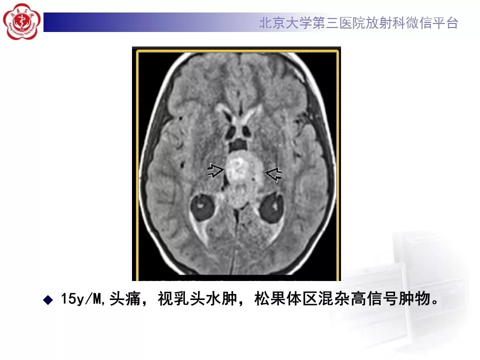 【病例】松果体区生殖细胞瘤1例CT及MR