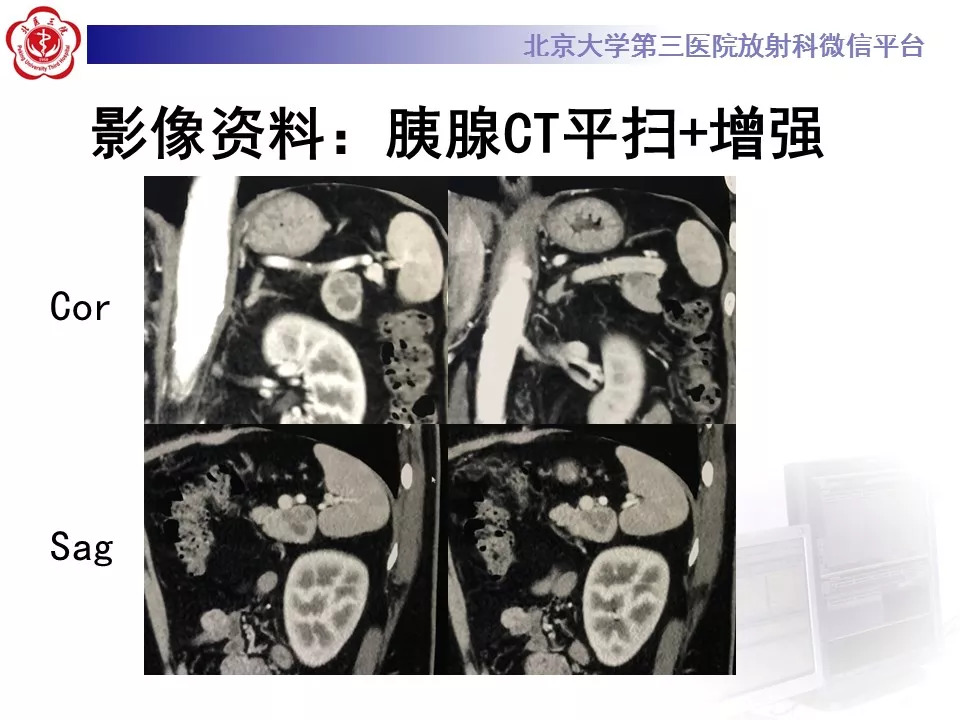 【病例】胰腺内副脾1例CT