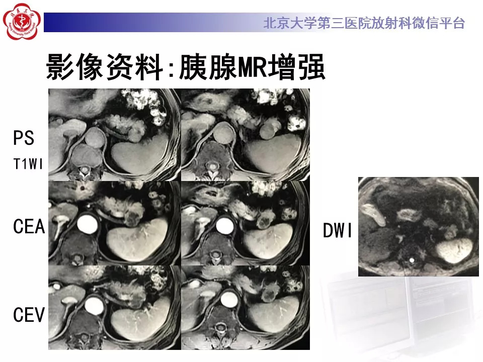【病例】胰腺内副脾1例CT