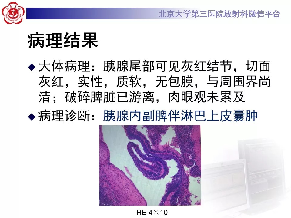 【病例】胰腺内副脾1例CT