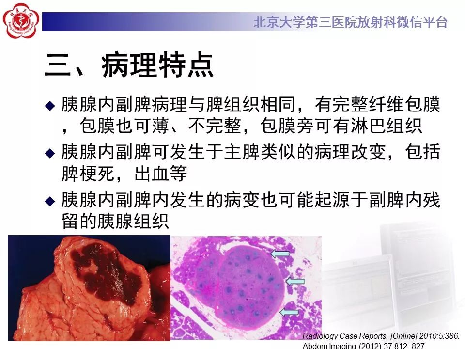 【病例】胰腺内副脾1例CT