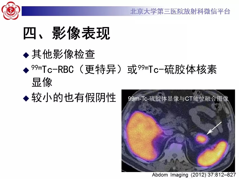 【病例】胰腺内副脾1例CT
