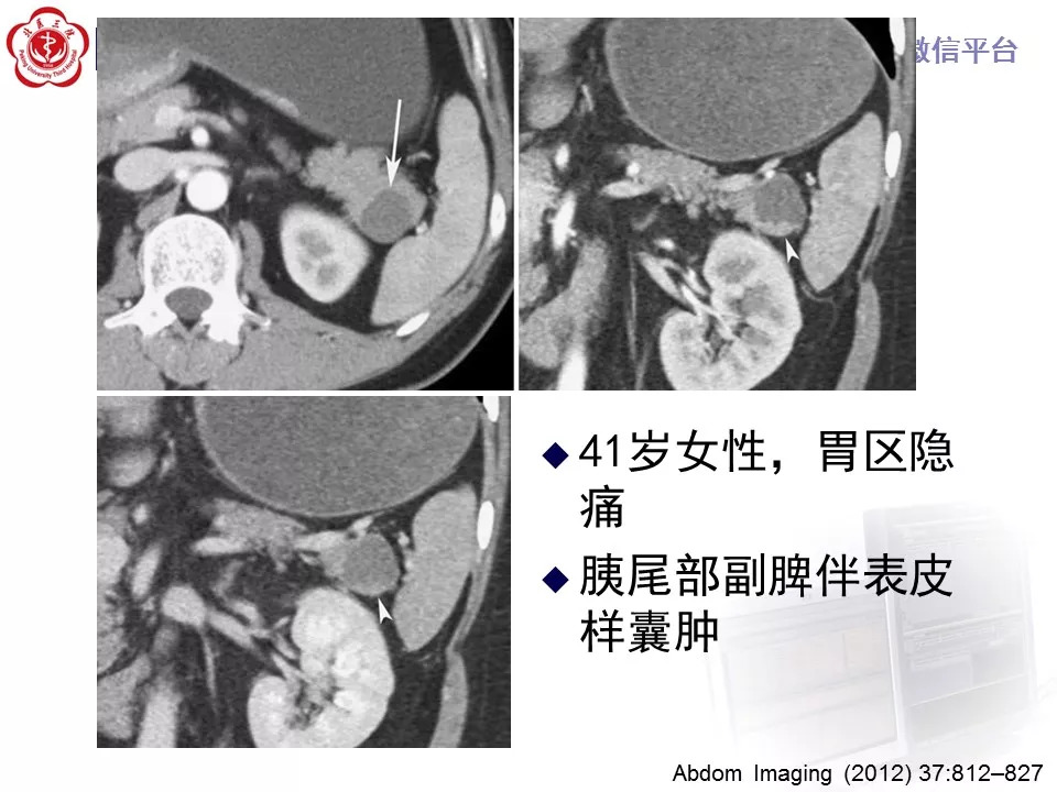 【病例】胰腺内副脾1例CT