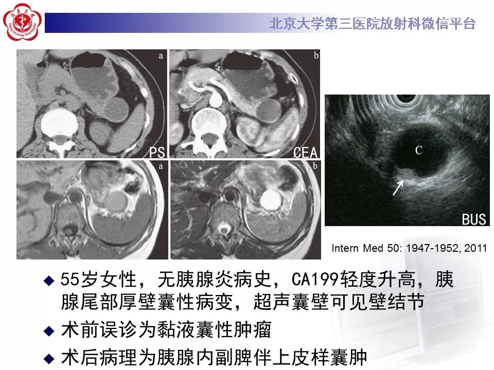 【病例】胰腺内副脾1例CT