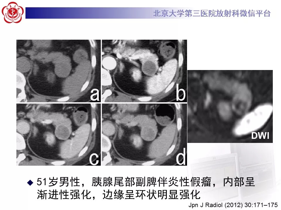 【病例】胰腺内副脾1例CT