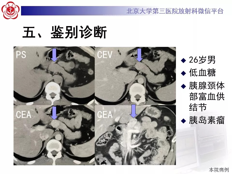 【病例】胰腺内副脾1例CT