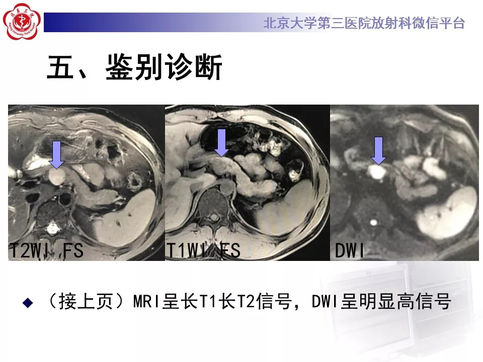 【病例】胰腺内副脾1例CT