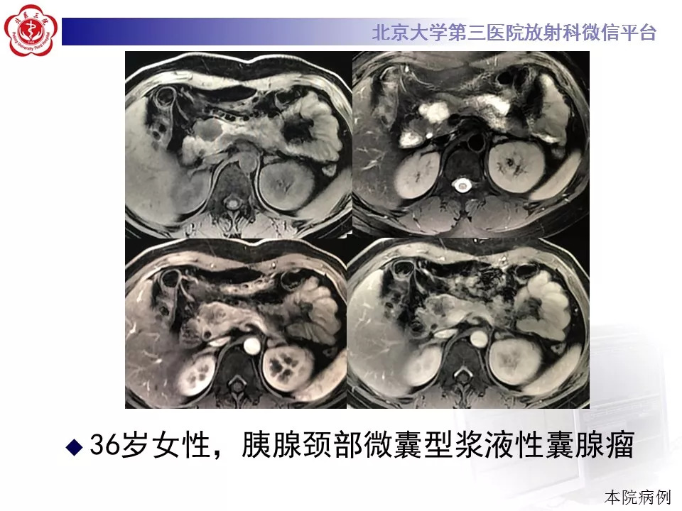 【病例】胰腺内副脾1例CT