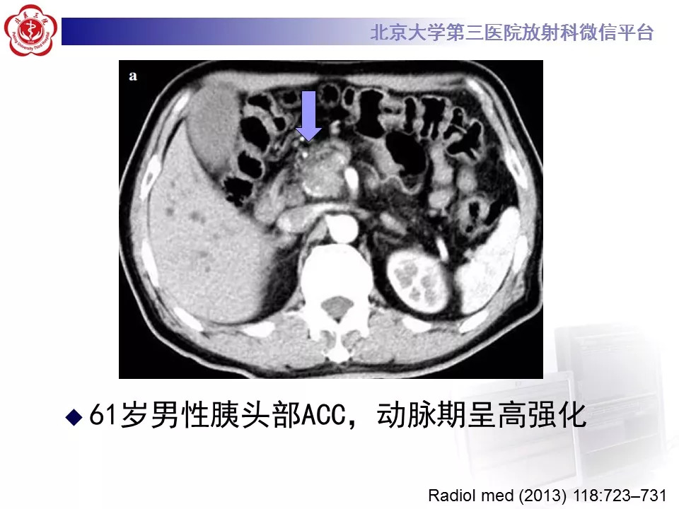 【病例】胰腺内副脾1例CT