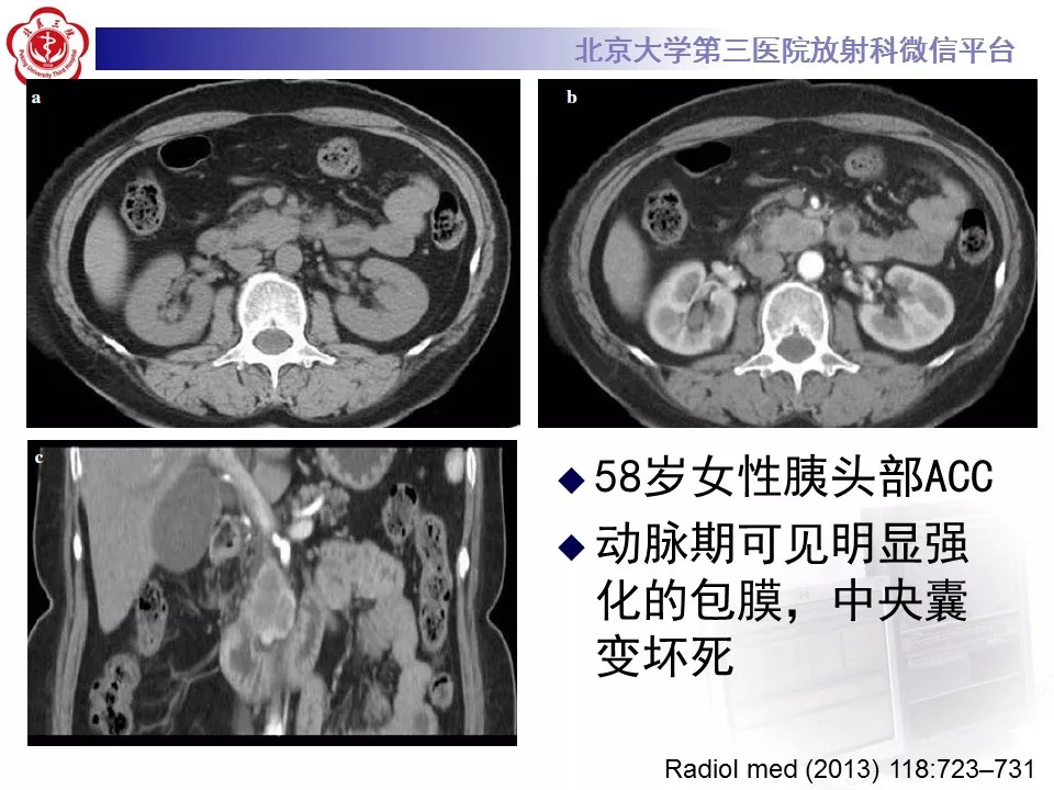 【病例】胰腺内副脾1例CT