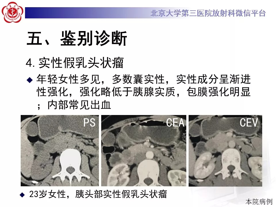 【病例】胰腺内副脾1例CT