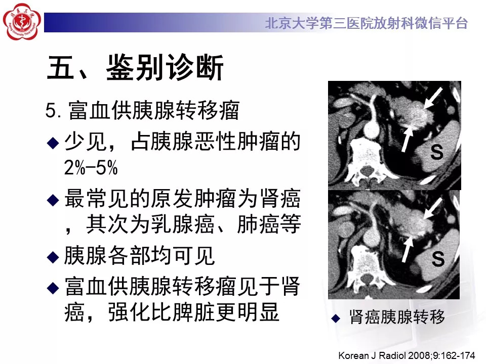 【病例】胰腺内副脾1例CT