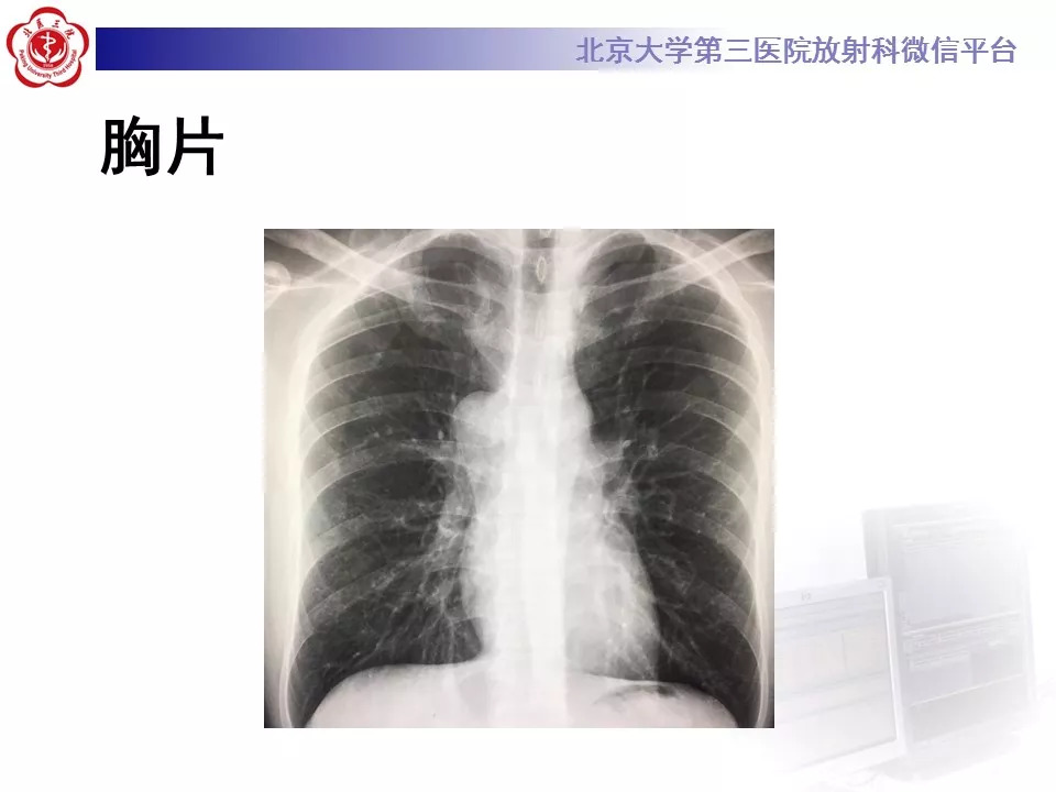 【病例】纵隔巨大淋巴结增生症1例CT