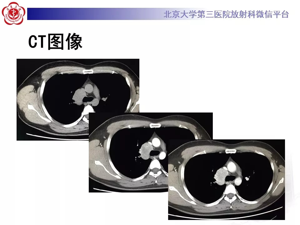 【病例】纵隔巨大淋巴结增生症1例CT