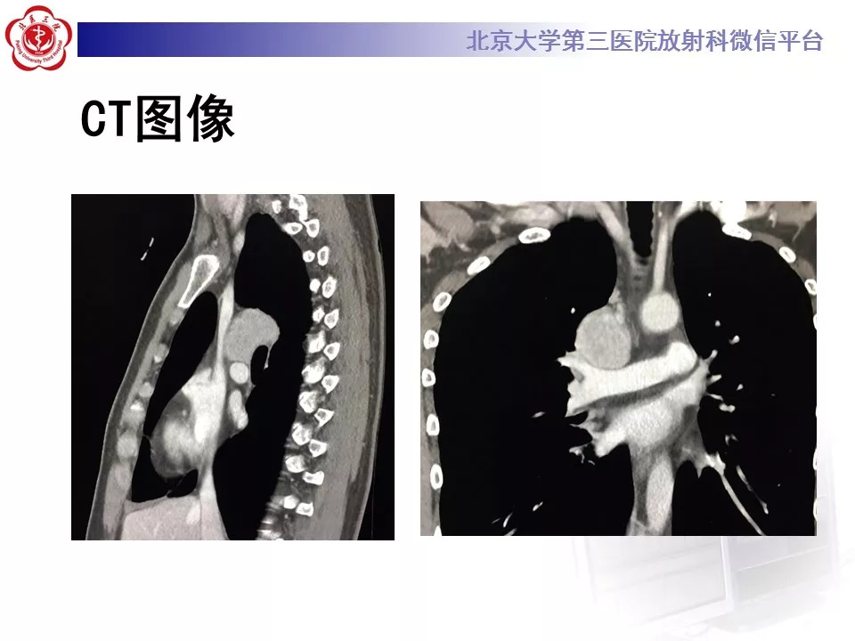 【病例】纵隔巨大淋巴结增生症1例CT