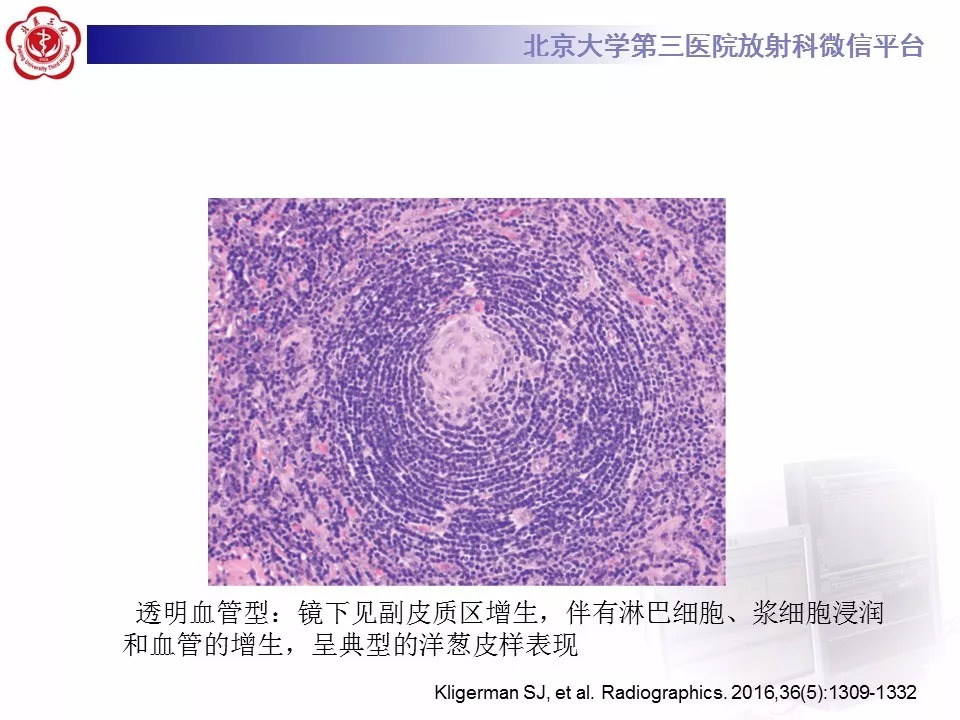【病例】纵隔巨大淋巴结增生症1例CT