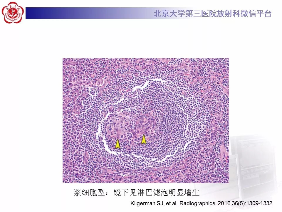【病例】纵隔巨大淋巴结增生症1例CT