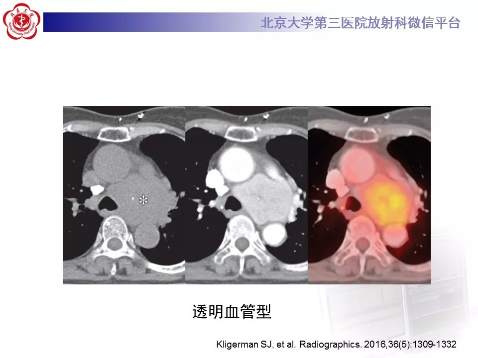 【病例】纵隔巨大淋巴结增生症1例CT