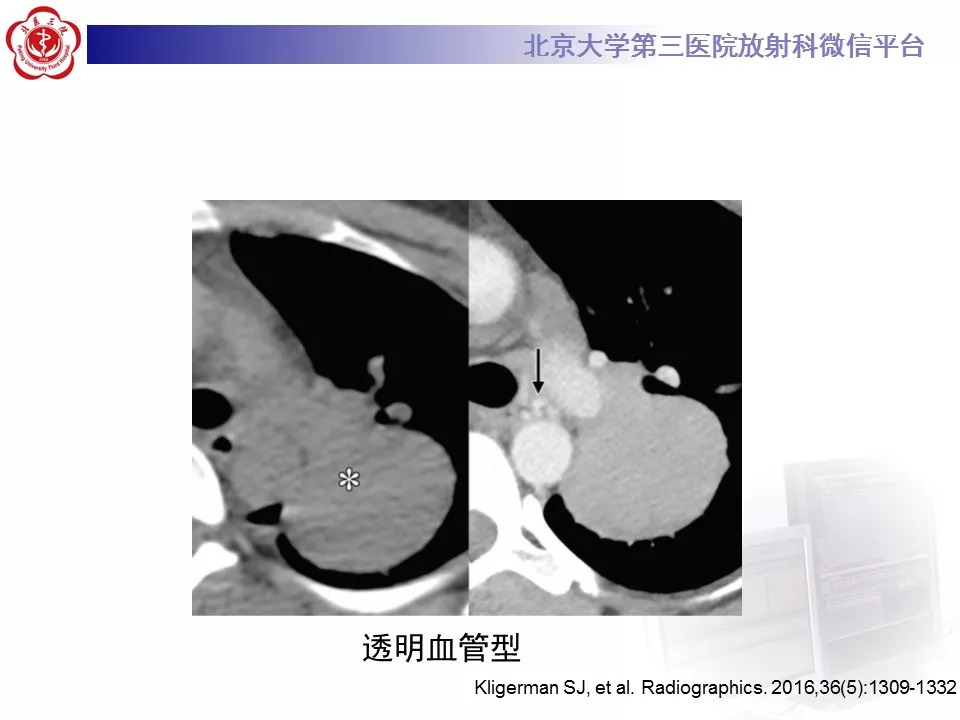【病例】纵隔巨大淋巴结增生症1例CT