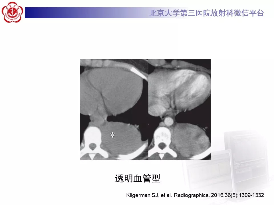 【病例】纵隔巨大淋巴结增生症1例CT