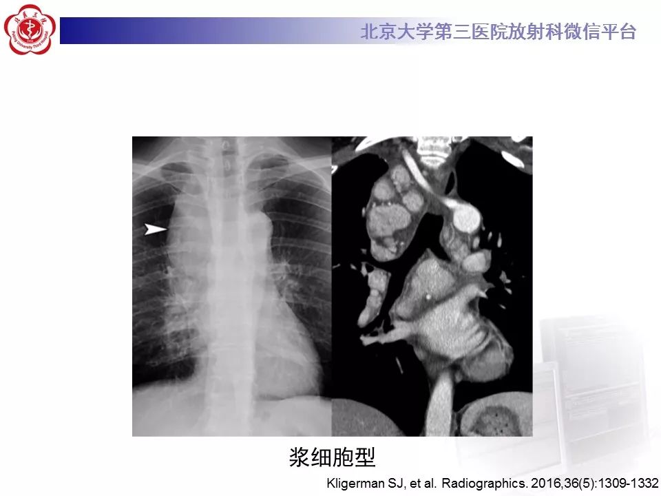 【病例】纵隔巨大淋巴结增生症1例CT
